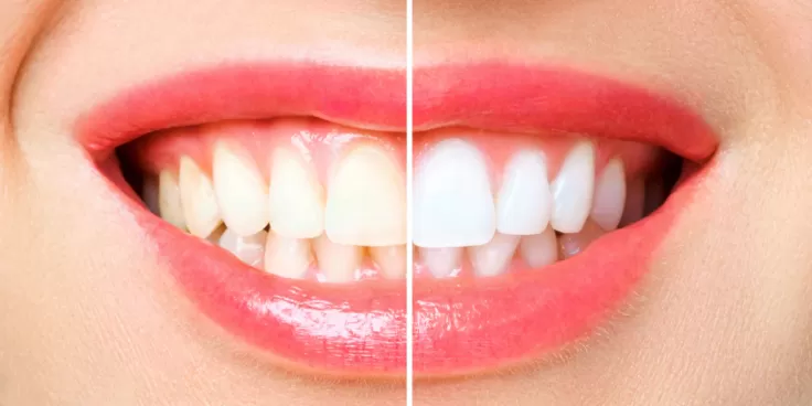 Comparaison des Prix du Hollywood Smile: Pourquoi la Turquie Surpasse la France